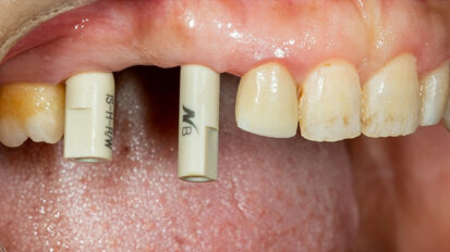 Digital implant restorations