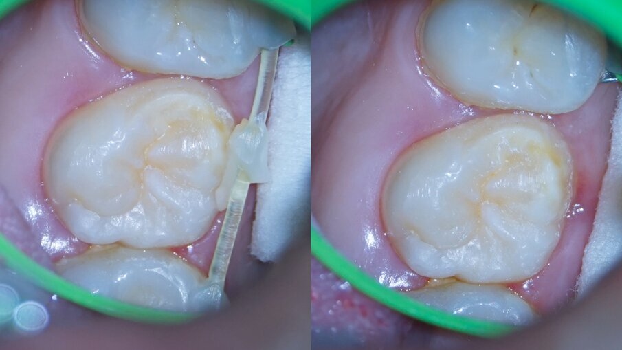 Figs. 5a & b: Fifteen days post-op. Healthy periodontal tissue was evident around the transplanted tooth, before (a) and after (b) splint removal. 