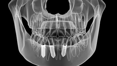 Учени са установили несъответствие между реалните и планираните имплантни позиции