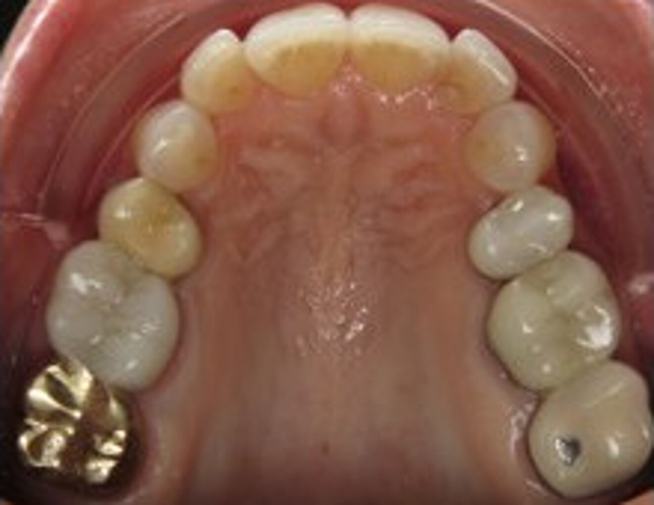 Figs. 9a–f: Photographs before and after aligner treatment showing resolved crowding and crossbite of the mandibular right canine, as well as improved overbite, overjet and arch symmetry. Before (a). 