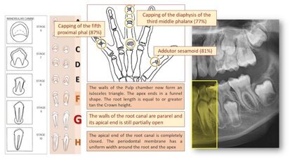 ¿Cuándo iniciar el tratamiento de Ortodoncia? ¿Cuándo iniciar el tratamiento de Ortodoncia?