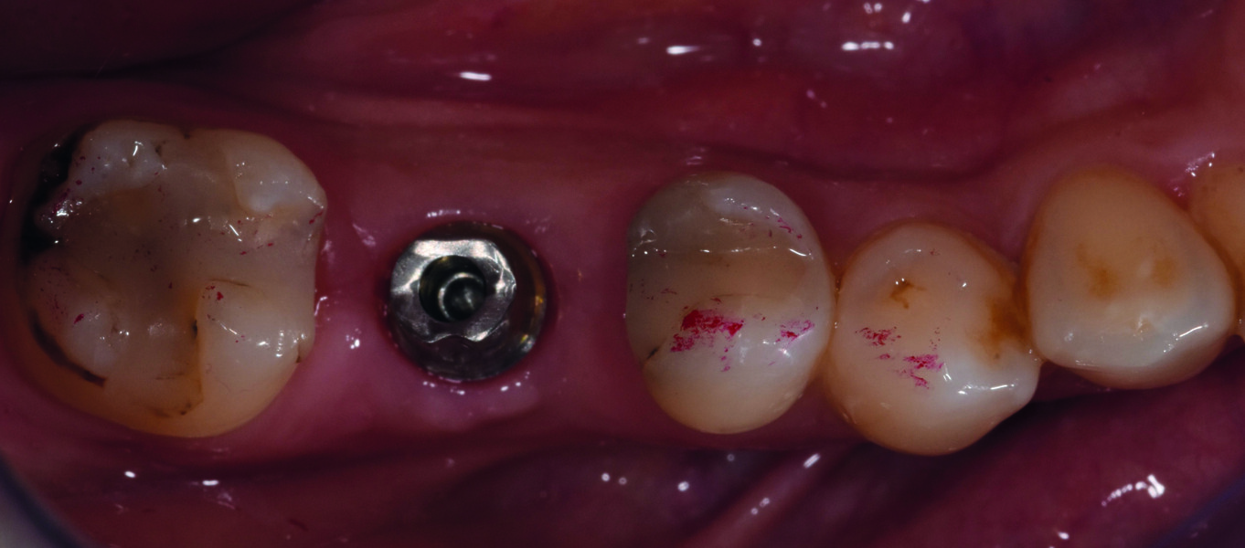 Fig. 21 : Vue occlusale du pilier, vissage à 30 N/cm. 