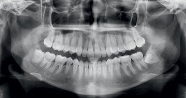 Distalizace horních molárů pomocí alignerů a cyklických sil