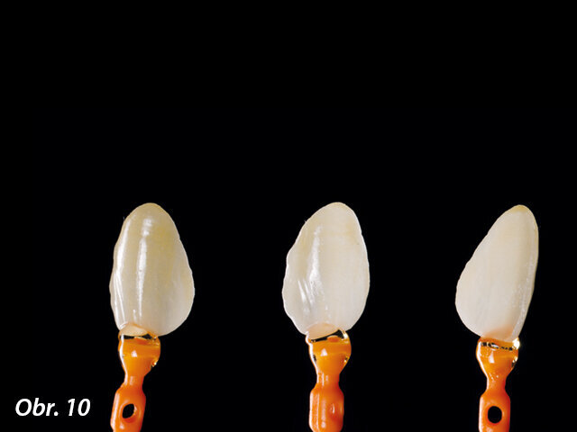 Obr. 10: Fazeta připravená na fixaci v ústech pacienta.