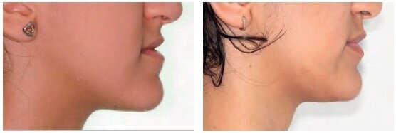 Photos from appointments 1 to 5b showing treatment progress despite infrequent visits: Initial bonding / 12 months / 19 months / 26 months / 33 months / Before and after photos