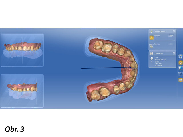 Sken horního zubního oblouku.