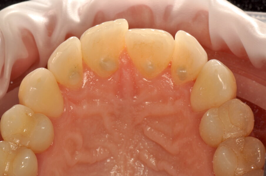 Figg. 5a-5c - Rivalutazione a 2 settimane si noti la completa risoluzione dell’infiammazione gengivale, nelle visioni vestibolare (5a), palatale (5b) e linguale (5c).