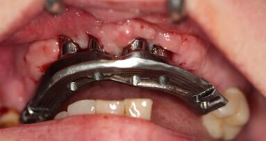 Kompromisowe leczenie implantoprotetyczne w strefie estetycznej