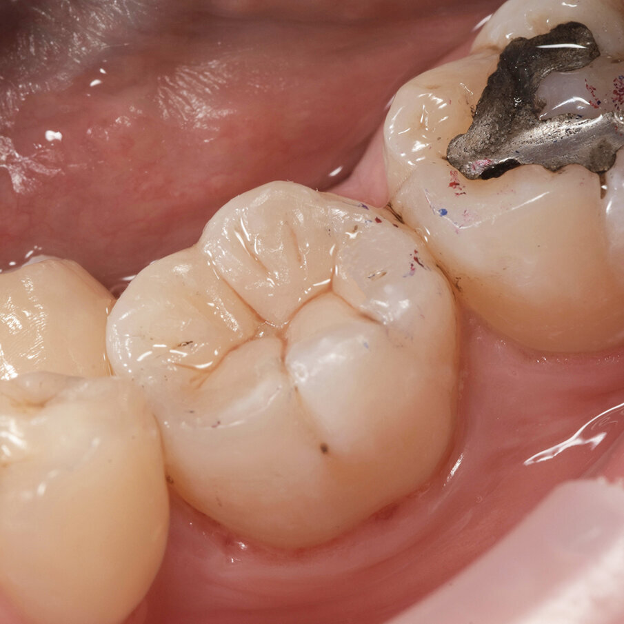 Fig 11: Final restoration after removal of rubber dam 