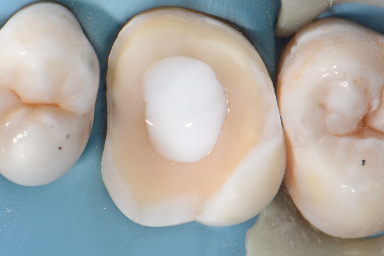 Fig. 15b: Access cavity closed with the liquid dental dam.