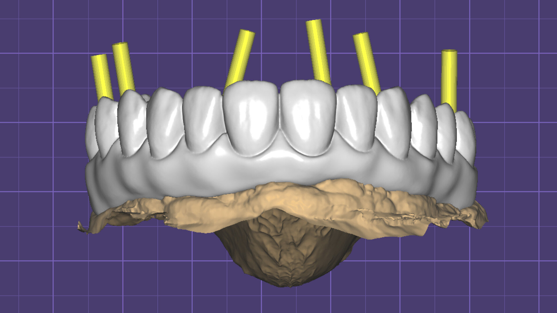 Efficient production of a hybrid implant-supported full-arch prosthesis