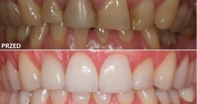 Regeneracja kości i pokrycie recesji w leczeniu estetyczno-implantologicznym