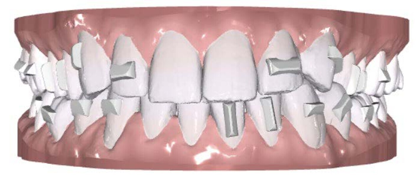 Fig. 8: Plan (3D set-up) of the attachments and their placement for the case demonstrated.