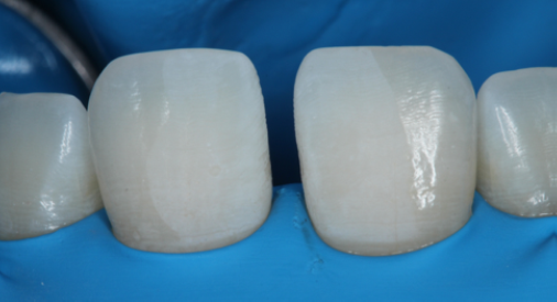 Fig. 6: Dried enamel surface