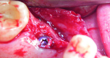 Guided bone regeneration in smokers - Use of synthetic bone blocks