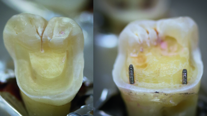 Exploring the fracture resistance of retentive pin-retained e.max press onlays in molars