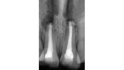 Apexification with mineral trioxide aggregate (MTA): A case report