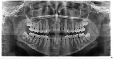 Trattamento di un paziente adulto con affollamento lieve-moderato mediante NOXI