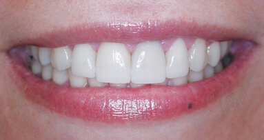 Making a single veneer blend so naturally it’s undetectable