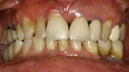 L’utilizzo di monconi in  zirconio per il miglioramento  dell’estetica rosa