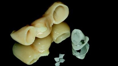 Caratteristiche del cemento ideale per sovrastrutture implantari