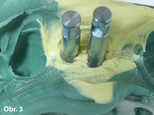 Obr. 3: Otisk situace s našroubovanými replikami implantátů