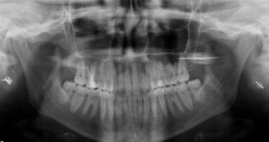 Irrigation for the root canal and nothing but the root canal