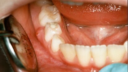 Milchzahnendodontie in der zahnärztlichen Allgemeinpraxis