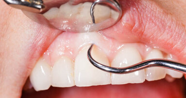 Free oral cancer screenings to be offered throughout parts of Australia