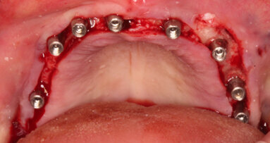 Protesi Toronto con tecnica CLIKSS