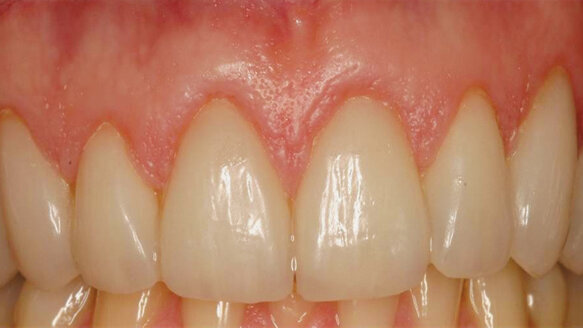 Two-stage esthetic crown lengthening