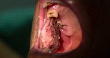 Kryzys COVID-19 może negatywnie wpłynąć na wykrywalność nowotworów jamy ustnej