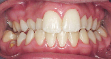 Tongue Star 2 (TS2) – systém pro rychlou léčbu otevřeného skusu