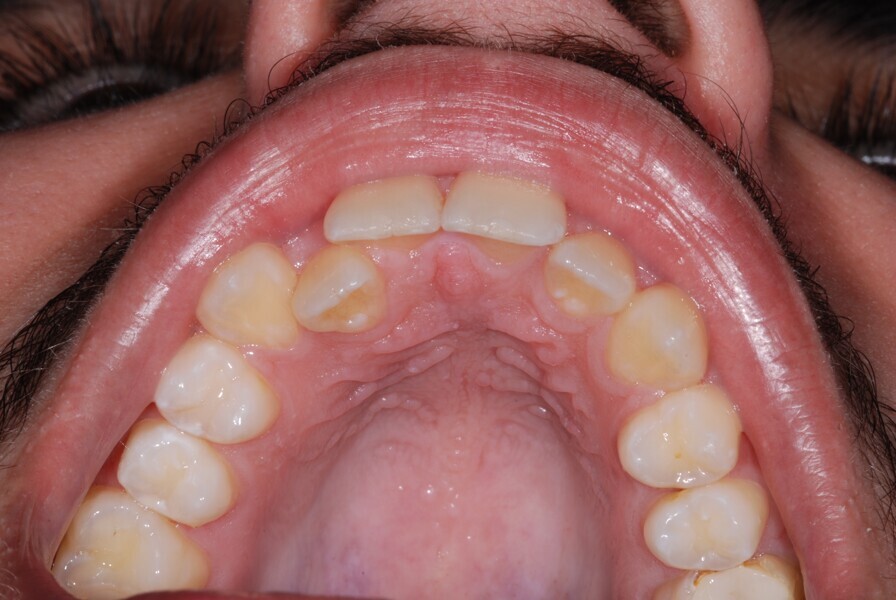 Fig. 31: Occlusal view before treatment.