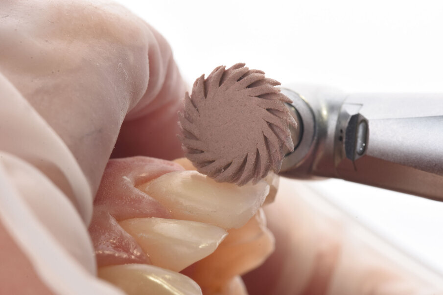 Sl. 14: Završna obrada i poliranje restauracije