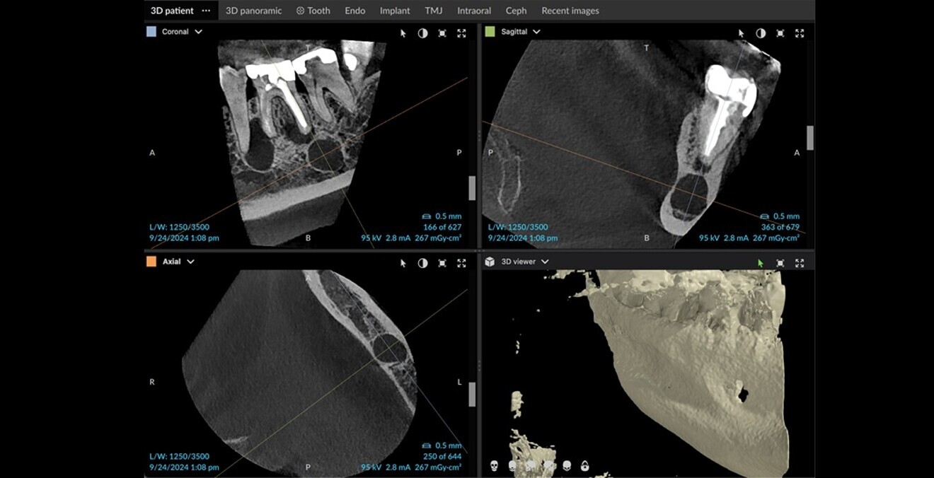 Figs. 4a–d: After adjusting the axial view according to the roots, the extent of the lesions and the separation between the lesions could be seen clearly.