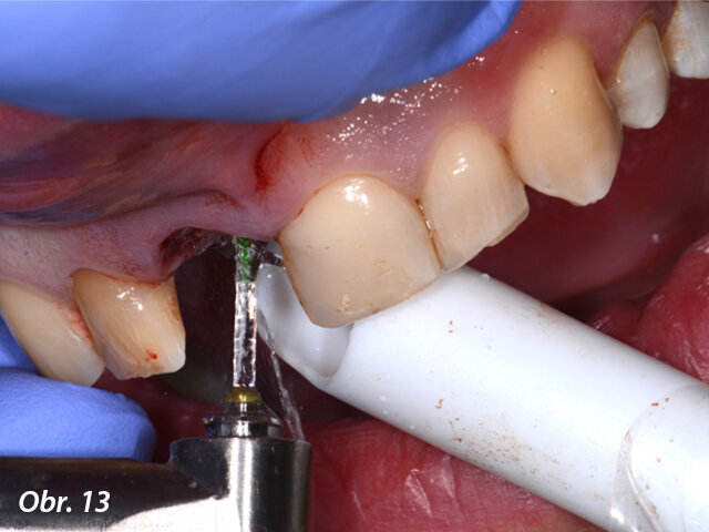 Odstranění granulační tkáně laserem Er:YAG Fotona (koncovka H14).