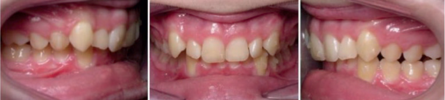 3 month progress records (weekly aligner changes)