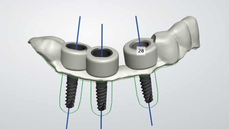 Prima operație dentară condusă de robot, a fost efectuată în China