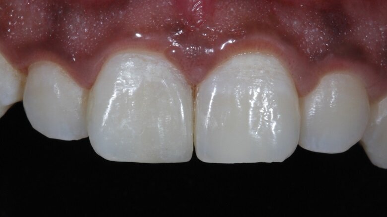 Fig 19: Symmetry achieved