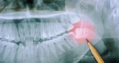 Aktualisierte S2k-Leitlinie zur Weisheitszahnentfernung