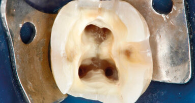PIPS: un approccio biomimetico all’anatomia endodontica