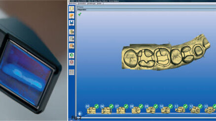 Simplified digital impression-taking