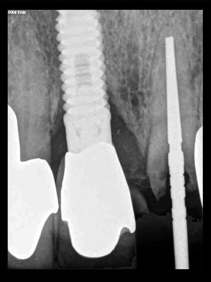 Fig. 18: A periapical radiograph
with a drill in place confirmed that the apex length had been reached and that all the gutta-percha had been removed.