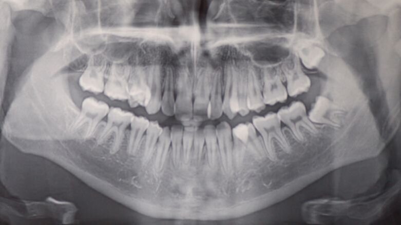 Gestione della terapia estrattiva: case report