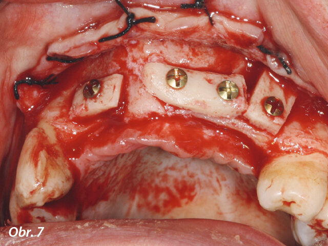 Kostní štěpy byly odebrány z bradové symfýzy a pevně zajištěny v místě transplantace chirurgickými šroubky.
