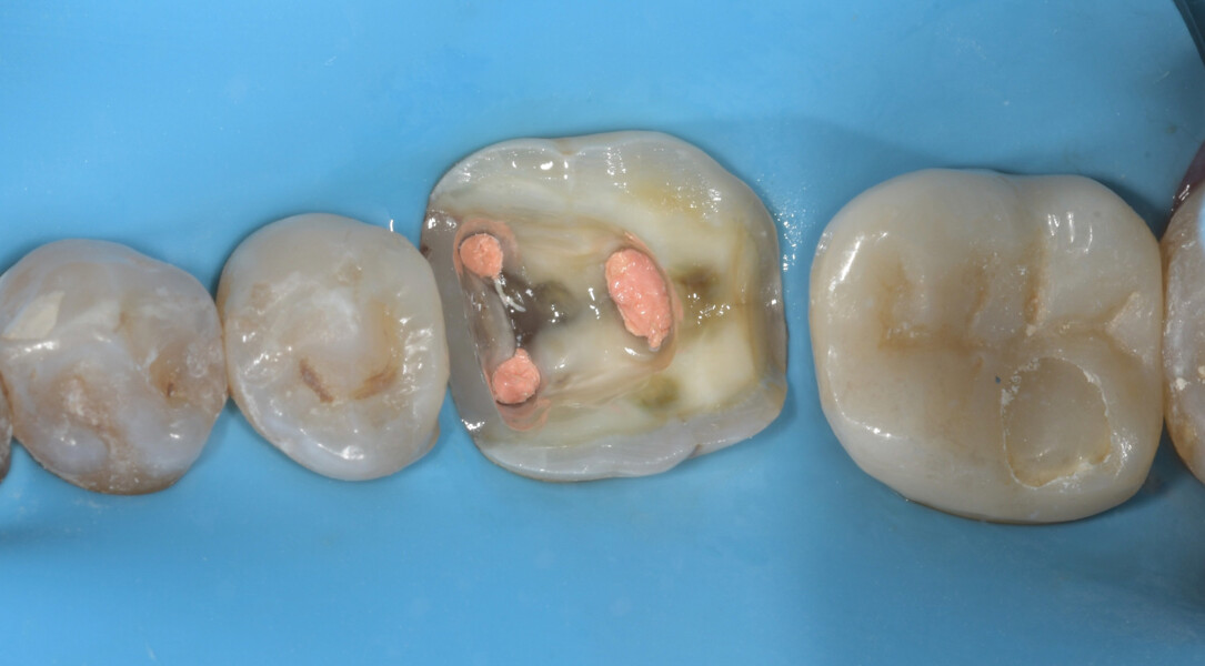 Fig. 20a: Endodontic treatment of tooth #36: after obturation. 