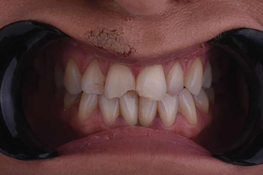 Sl. 2: Pozicija frakturiranih zuba u maksimalnoj interkuspaciji