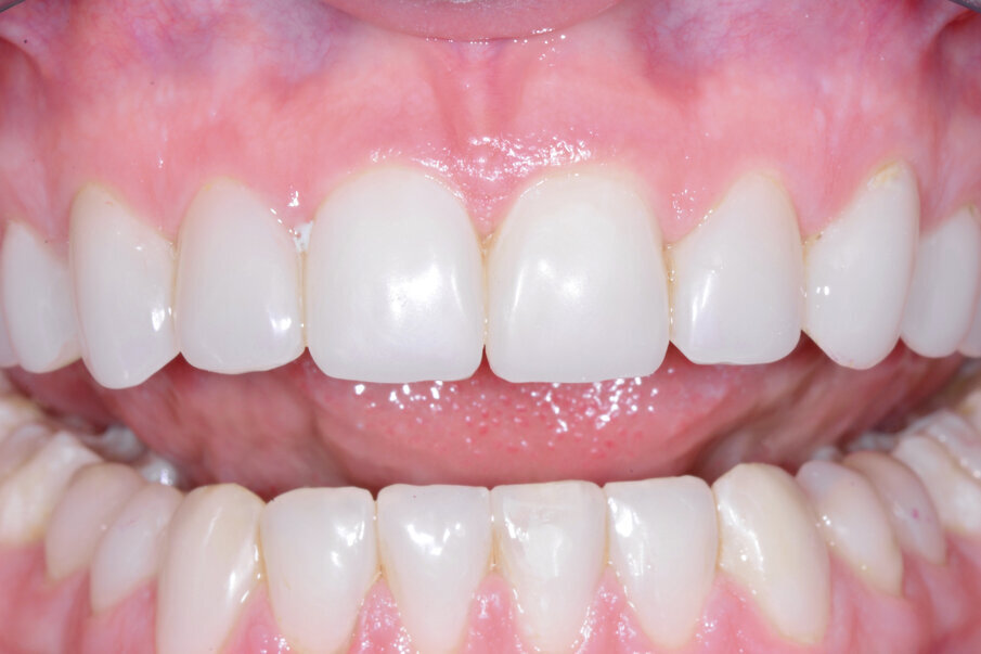 Figs. 14: Restoration in amelogenesis with classical COMPONEER