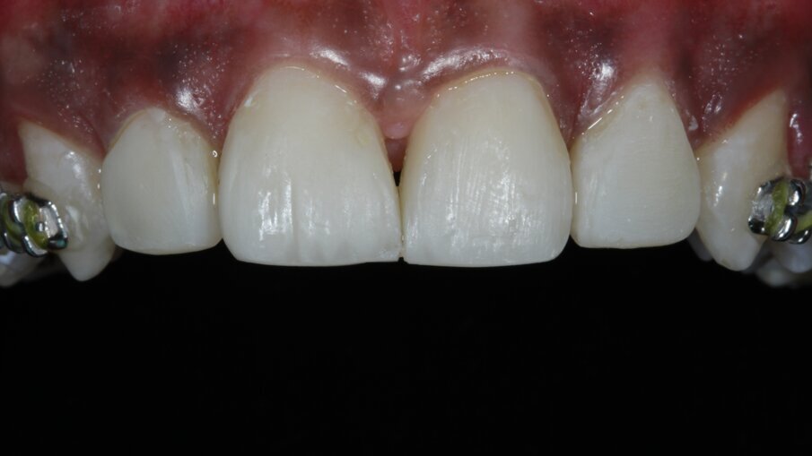 Fig 18: Incisal edge build-up